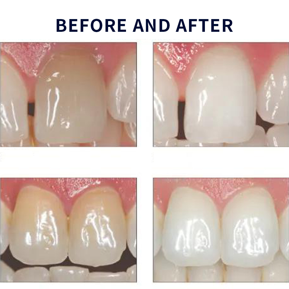Opalescence Whitening 20% PF 2 - Teeth Whitening Near Me recension och pris