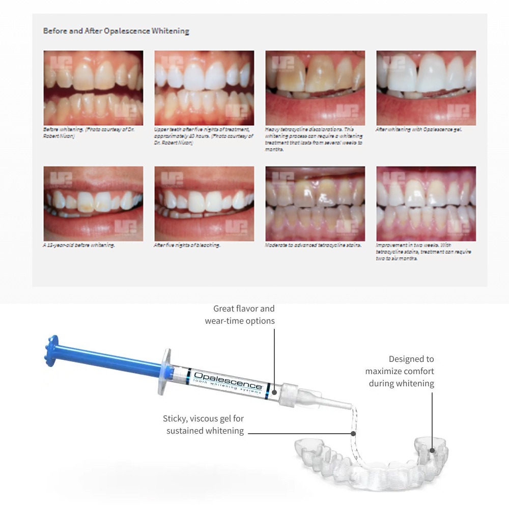 Opalescence Whitening 20% PF 2 - Teeth Whitening Near Me recension och pris