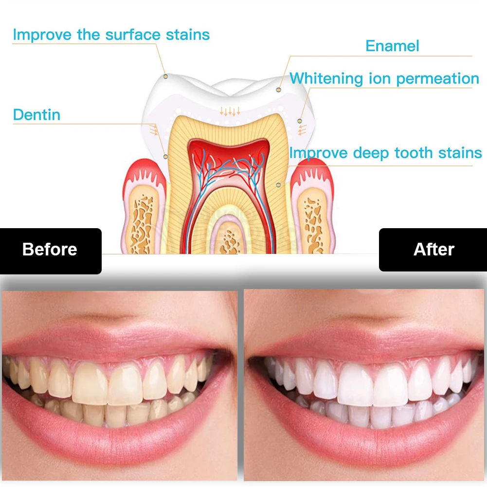 Dental Teeth Whitening Kit Min - Teeth Whitening Near Me recension och pris